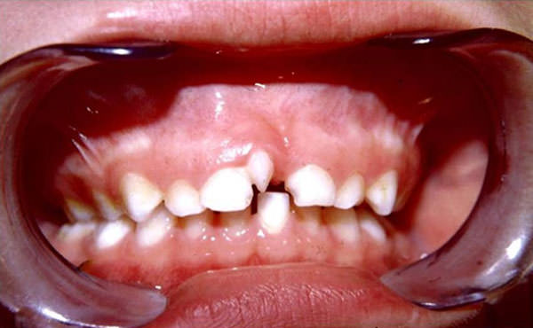 Fig.2 Mesiodens