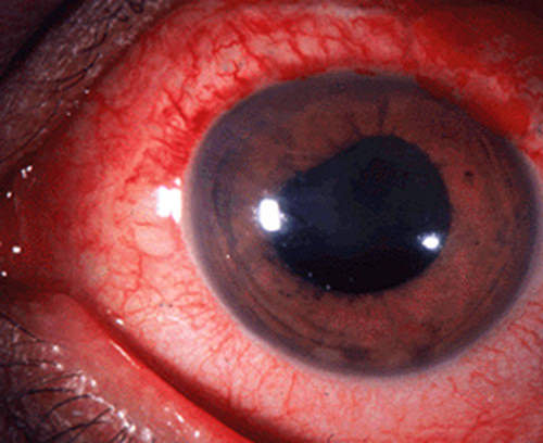 Figura 1 Fotografía clinica de uveítis, donde se observa inflamación, enrojecimiento del ojo. Tomado de Patología Úveal, Madrid, 2007.