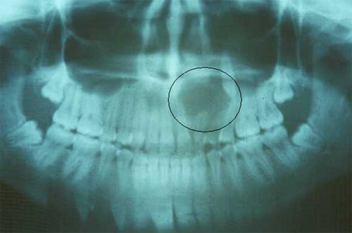 Figura 5 Radiografía panorámica, donde se observa foco infeccioso de origen odontogénico. Tomado de acta odontológica venezolana, 2002