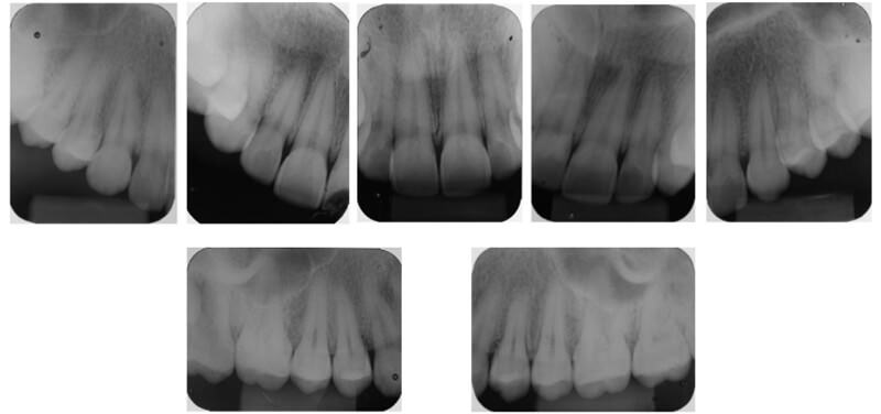 Figura 2.Radiografías pericapicales iniciales para la realización del análisis de la unión cemento-esmalte en relación a la cresta ósea alveolar.
