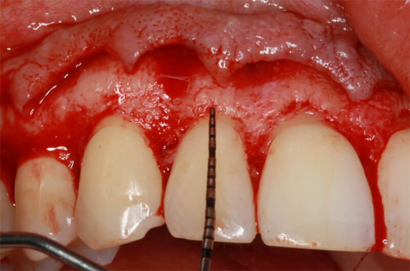 Figura 8. Vista frontal de la región de premolares a premolares, evidenciando la realización de desplazamiento de colgajo a espesura total.Figura 9. Medición con sonda periodontal de la distancia entre la unión cemento esmalte y la cresta ósea en cada elemento dental.