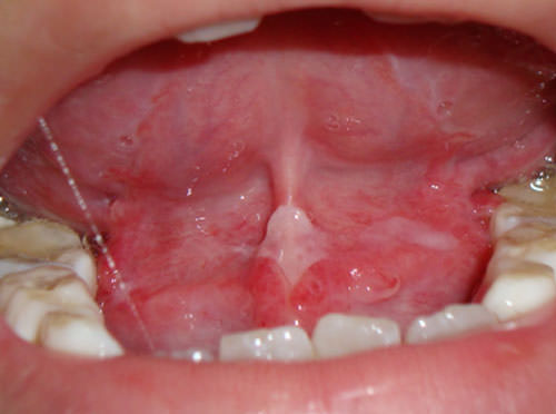 Figura 3 Lesiones de mucositis oral sublingual.