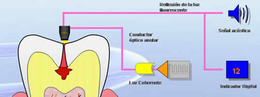 Esquema de funcionamiento del dispositivo DIAGNOdent (45)