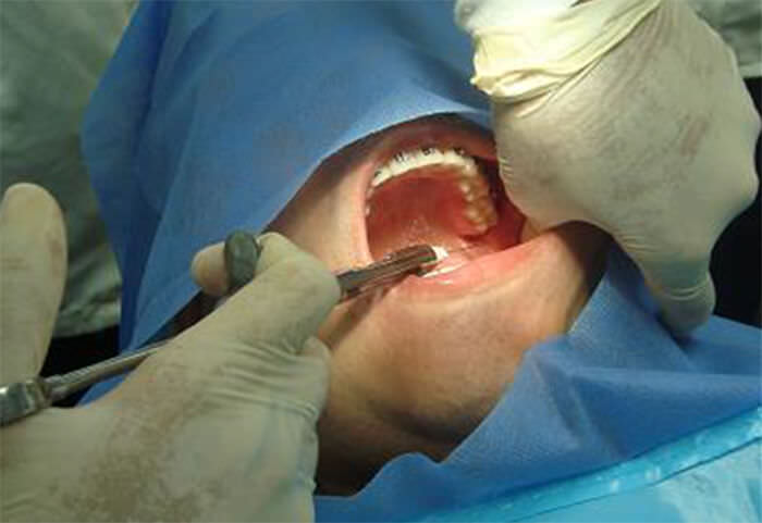 Imagen 3. Técnica Troncular