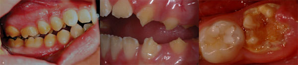 Figura 2 Amelogenesis Imperfecta en a: AI hipomaturada, caracterizada por opacidades demarcadas en grupos de dientes y en b: AI hipoplásica, caracterizado por la fina capa de esmalte en general