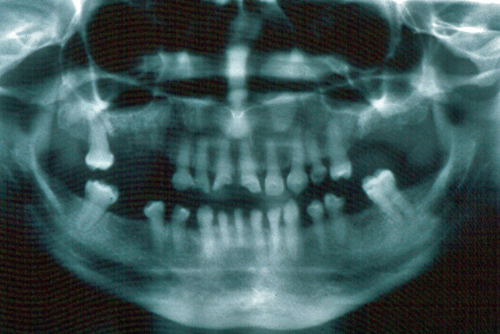 Fig. Nº 3: En la radiografía panorámica se evidencian las características radiográficas de la D.I.