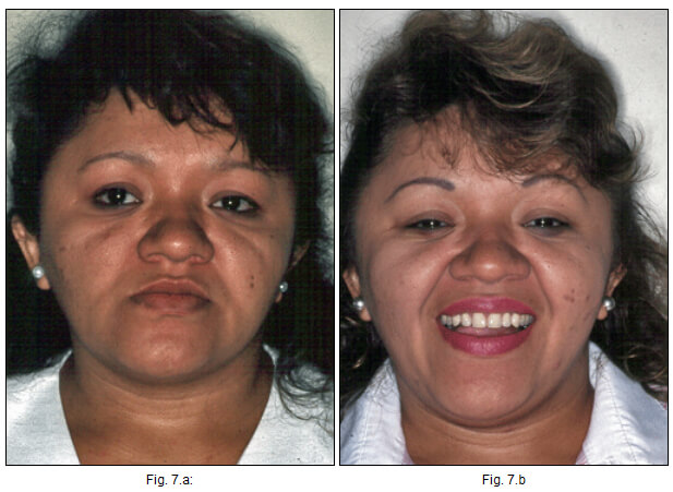 Fig. Nº 7: Vista clínica extrabucal del paciente antes y después del tratamiento. Nótese el cambio en la dimensión vertical y la expresión facial.