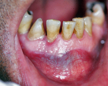Figura 1 Aspecto clínico intrabucal